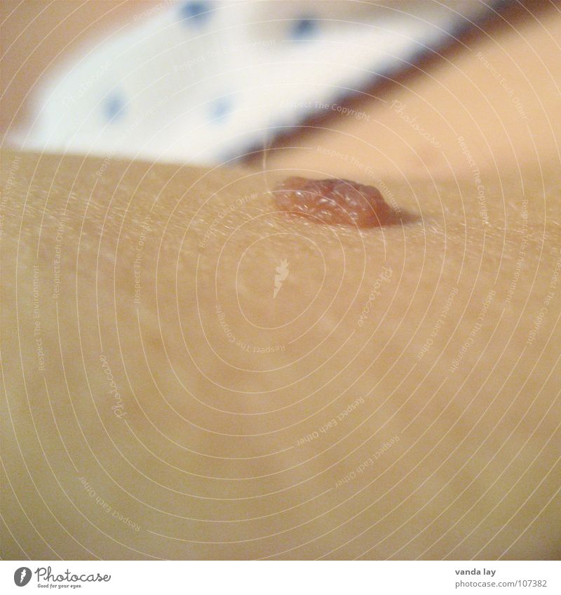 Skin cancer? Mole Three-dimensional Underpants Blemish Macro (Extreme close-up) Close-up Fear Panic Shellfish birthmark mother's mark maintenance