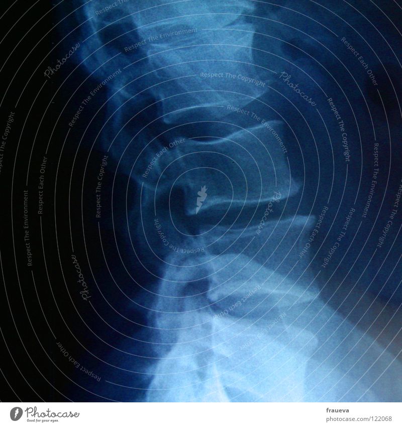 throat Spinal column Ribs Illness Doctor Health care X-ray photograph X-rayed Skeleton Healthy Neck Blue Diagnosis Radiology
