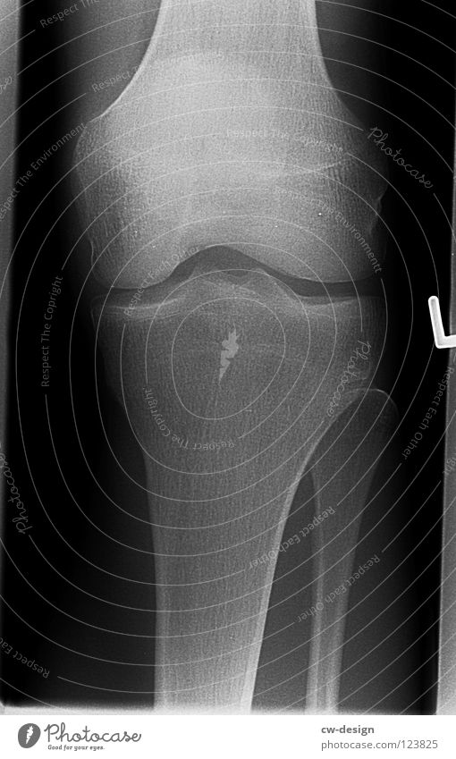 ghost X-ray photograph X-rays Skeleton Thigh Lower leg Tibia Joint Knee cap Ankle joint Osteoarthritis Fracture Illness Left Sudden fall Black Light