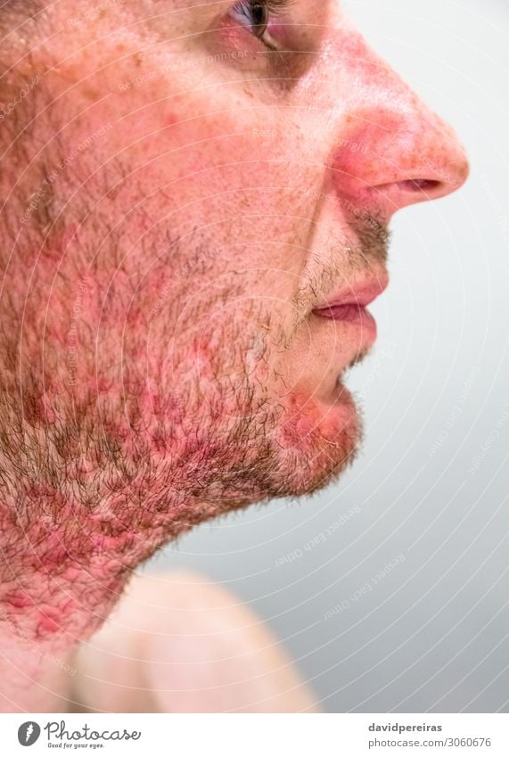 man's chin with seborrheic dermatitis in beard Skin Face Medical treatment Illness Allergy Medication Human being Man Adults Beard Authentic Red Irritation
