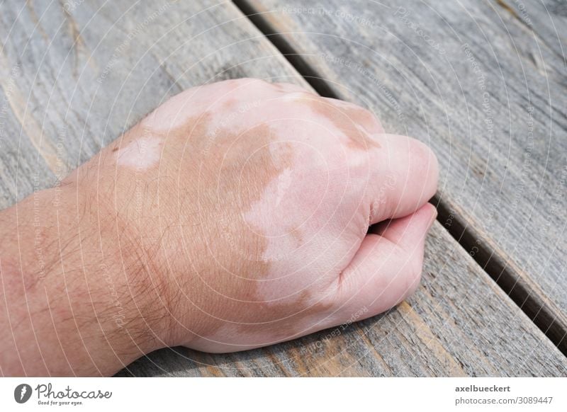 vitiligo or white spot disease Healthy Health care Illness Human being Masculine Man Adults Hand 1 18 - 30 years Youth (Young adults) 30 - 45 years White Skin