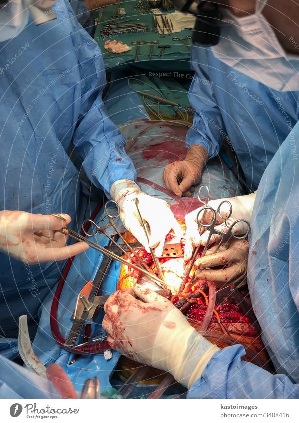 Surgeons team performing organ transplantation medical surgery. medicine surgeon operating hospital doctor equipment sterile operation blood sternotomy