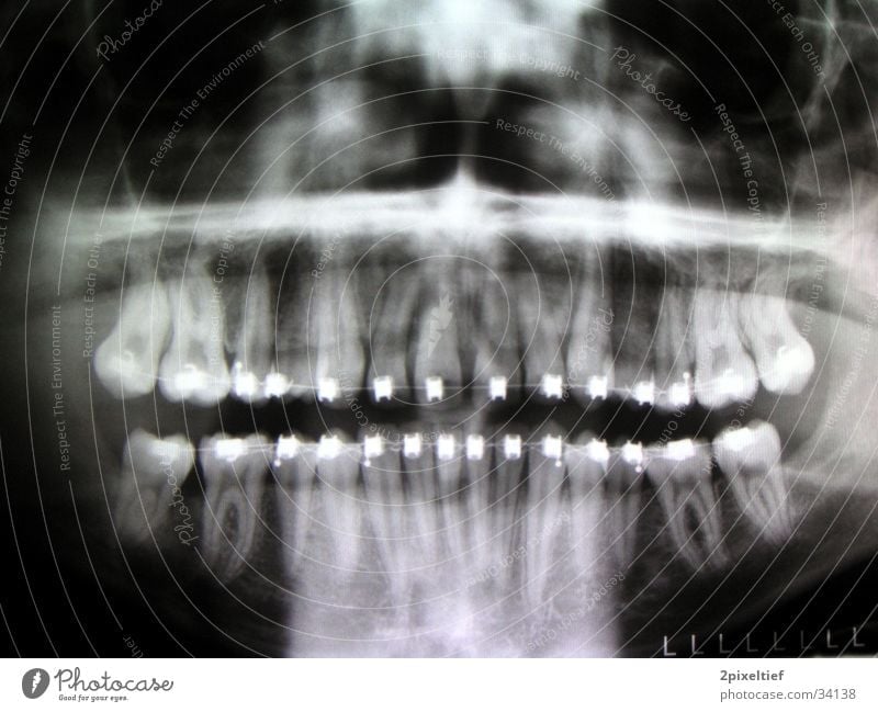 tin face Black Repair Man Pine Metal orthodontics knowing Teeth Radiology