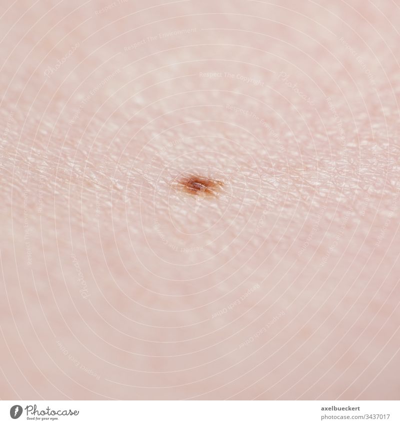 skin with mole dermatology nevus nevi liver spot beauty spot melanocytic lesion melanocyte dark small close-up macro melanoma human cancer medical closeup