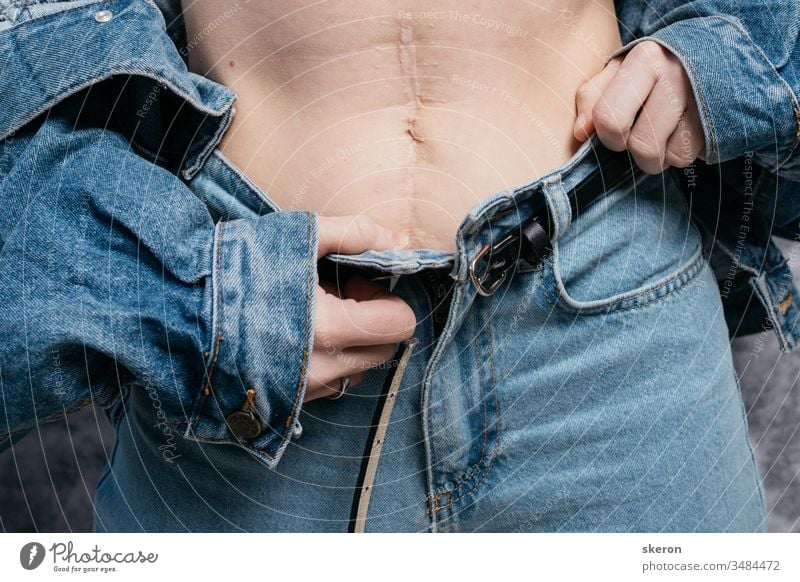 young slender girl shows a scar on her stomach after surgery. woman in stylish clothing: spring denim jacket and pants abdomen abdominal aesthetic anatomy