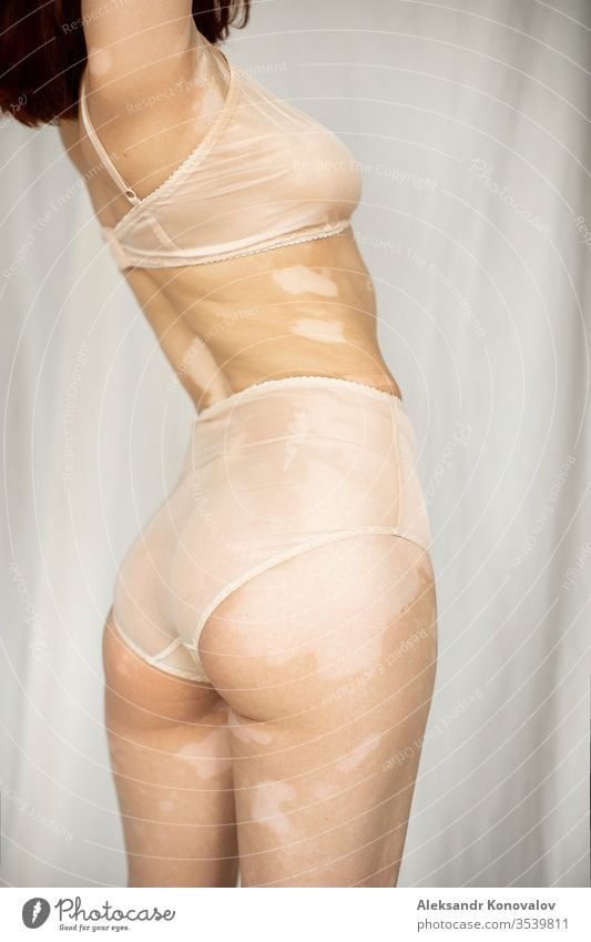 Young woman with pale skin and vitiligo stands on fabric backdrop in  natural light in transparent underwear - a Royalty Free Stock Photo from  Photocase
