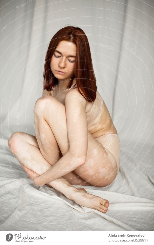 Young woman with pale skin and vitiligo stands on fabric backdrop