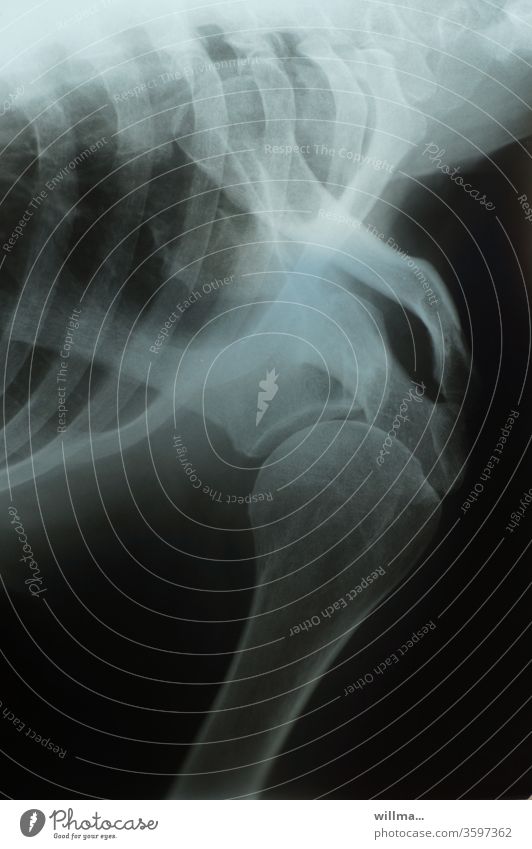 X-ray of shoulder joint and thorax with ribs X-ray photograph Shoulder Joint Ribs Radiology Bone X-ray diagnostics Health care Diagnosis Skeleton