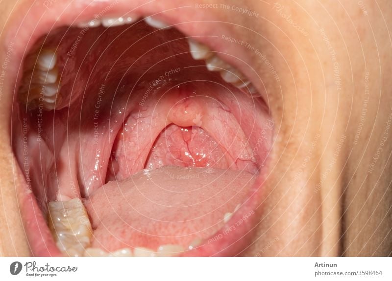 Sore throat with throat swollen. Closeup open mouth with posterior pharyngeal wall swelling and uvula and tonsil. Influenza follicles in the posterior pharyngeal wall. Upper respiratory tract.