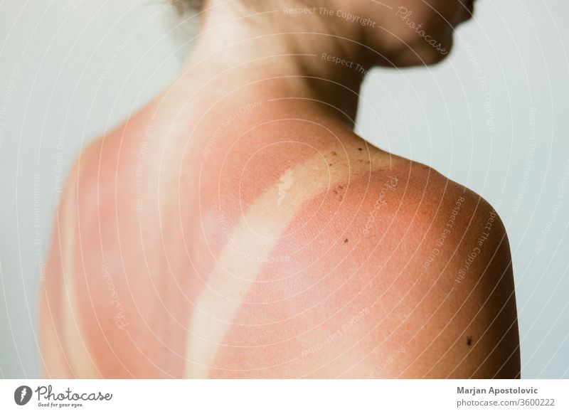 Close-up of a sunburn marks on a woman's back detail outline traces people isolated ultraviolet sunlight tanning beauty natural red health care skin shoulders