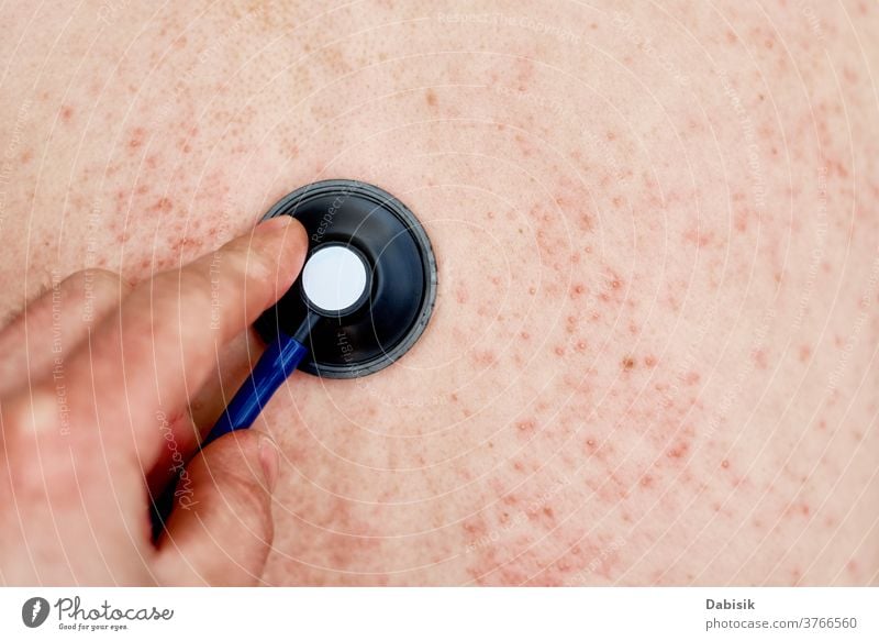 Allergic rash on skin. Woman with dermatology problem on back skin allergy eczema infection disease health medical body red dermatitis epidermis closeup