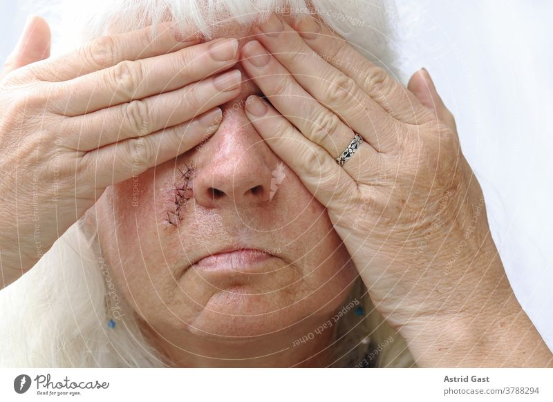 With scars on your face, you want to hide. An older woman has a scar on her face and is ashamed of it basal cell carcinoma load incriminating sensitive