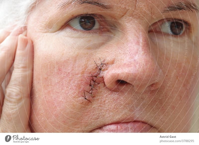 An older woman has a surgical scar on her face Face Skin Woman Senior citizen operation scar scars Scar Stitching Operation threads Accident Sewing