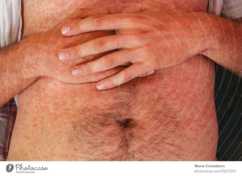 Measles or rubeola rash on Caucasian man's skin measles rash measles disease caucasian male medical skin condition symptoms infectious disease human medicine