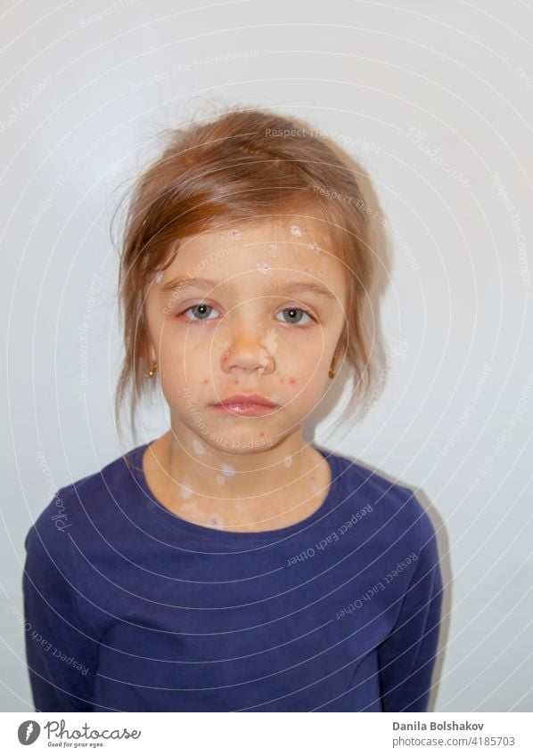 Sad little girl ill with varicella virus or chickenpox bubble rash on her face viral pediatric small looking at camera health care and medicine human face