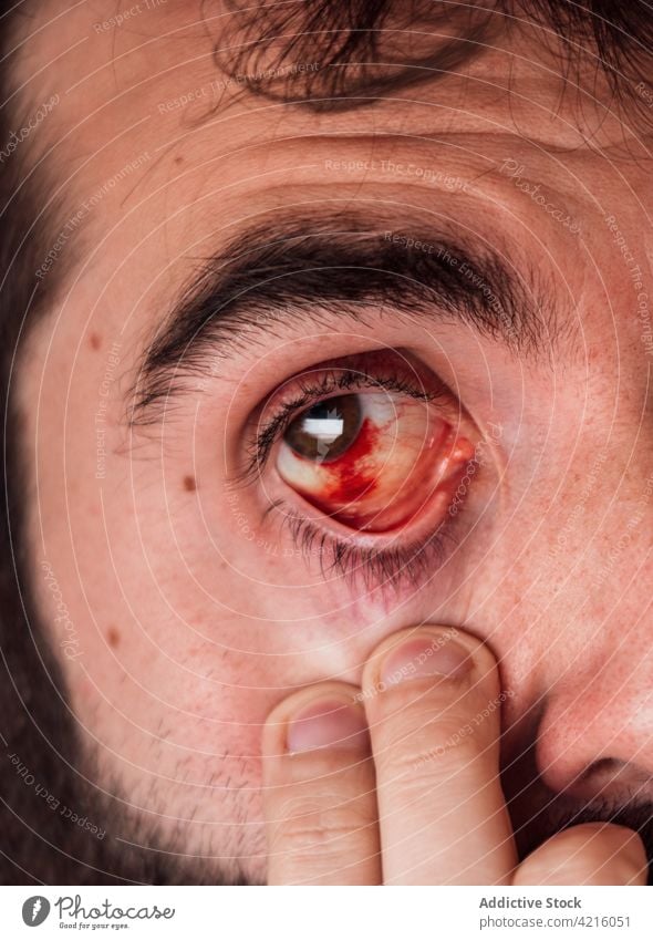 Man with bloodshot eye looking at camera man red vein inflame irritate infection sick injury male sore unhealthy problem symptom illness suffer unwell disease