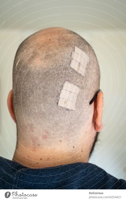 A man with a wound on the back of his head covered with plasters, vertical wounds male glasses white caucasian wounded hurt recover heal healing stitches
