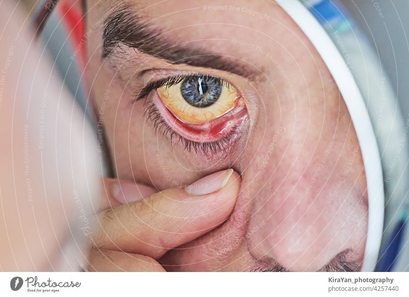 Human eye with yellow eyeball, closeup. Yellow eyes is a symptom of liver disease or hepatitis human eye yellow eyes liver infection bilirubin