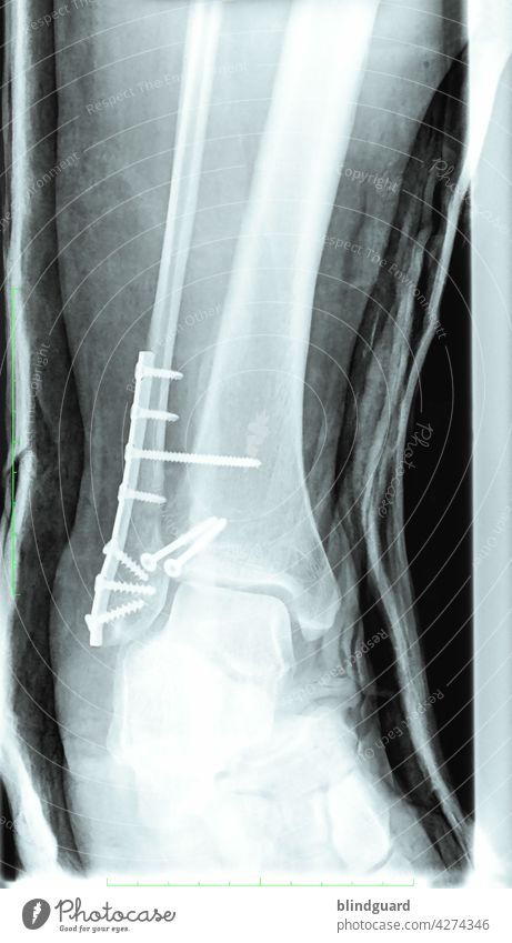 heavy metal X-ray photograph Bone Ankle joint leg Joint fixed Operation Radiology Skeleton WeberB Accident Fracture Doctor Health care Healthy Illness Screw