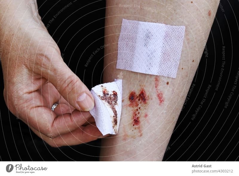 A woman has a bleeding injury on her leg Woman violation Wound sore bloody Pain wounded Accident pavement Connect Sore Tibia Hand Bandage bandage change Illness