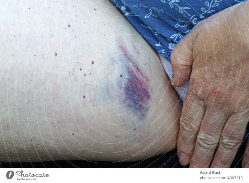 A woman has a large painful bruise (bruise) on the inside of her thigh. Woman leg Contusion bruised violation Wound Thigh inner thigh inside leg bleed bloody