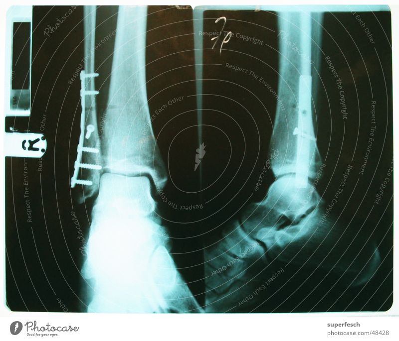 Everything's gonna be okay. To break (something) Rehabilitate Operation Broken Legs Feet Ankle Screw Radiology