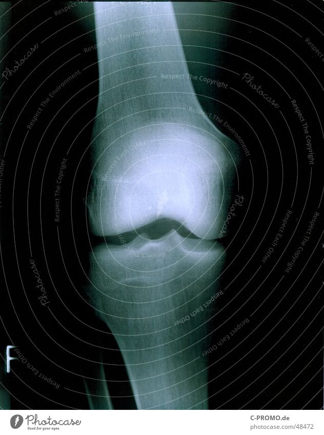 My right knee :: my right knees Health care Knee Doctor Joint Broken Knee cap Skeleton Radiation Black Light White Healthy chirog Human being fluoroscopy Pain