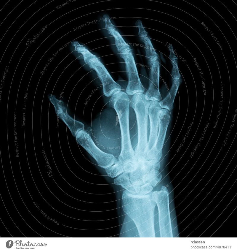 x-ray Image of a human right hand for a medical diagnosis xray admission Radiograph anatomy doctor medicine surgery transparenz body hospital