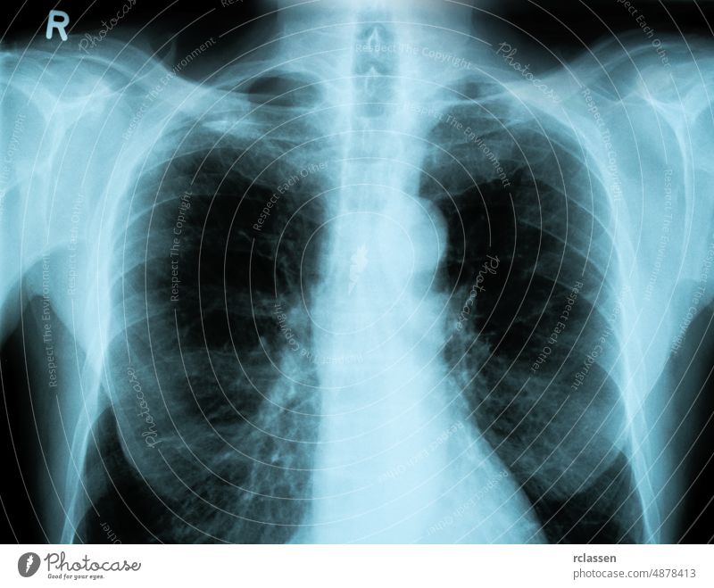 X-Ray Image Of Human Chest x xray x-ray admission Radiograph anatomy doctor medicine surgery medical transparenz body hospital human Preventive examination pain