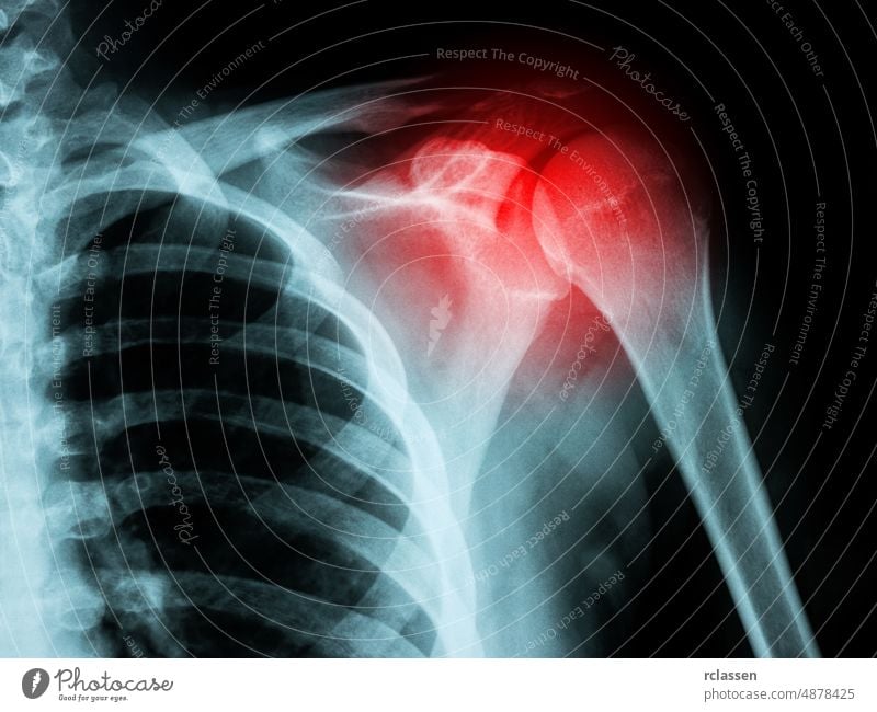 X-ray film of shoulder fracture pain human move creepy medical examination unhealthy radiation admission break skeleton male disease radiology scan black female