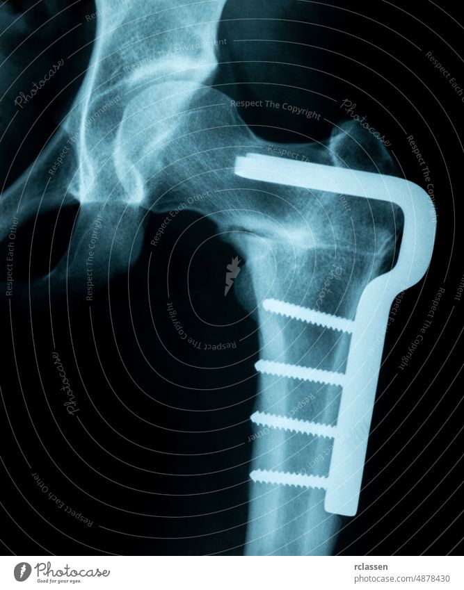 X-Ray Image of a broken pelvis/hip with metal pins holding it together x xray x-ray admission Radiograph anatomy doctor medicine surgery medical transparenz