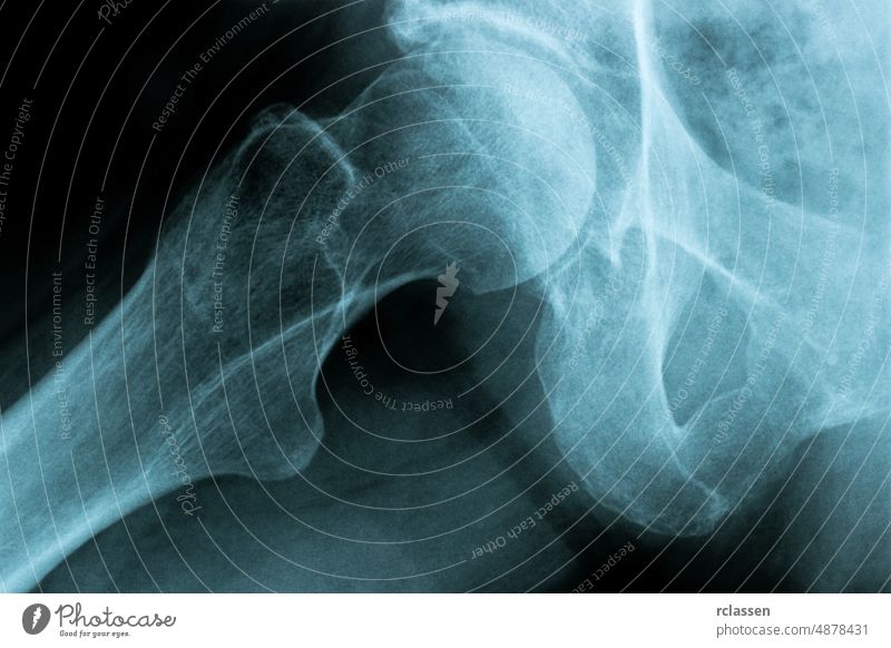 X-Ray Image of a Human Chest hip joint bone x xray x-ray admission Radiograph anatomy doctor medicine surgery medical transparenz body hospital human