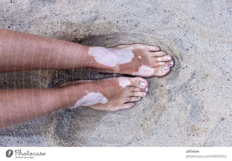 Legs and feet of woman with vitiligo pigment spot disease in the sand, copy space beach colored disorder melanin dermatitis autoimmune dermatologist chronic