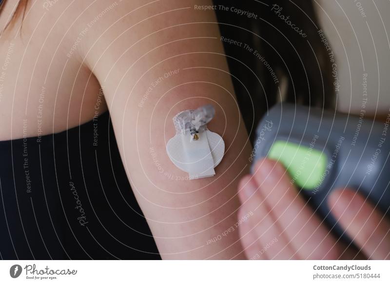 Blood glucose sensor just after insertion with the insertion device diabetes diabetes type 1 blood glucose sensor continuous glucose monitoring blood sugar