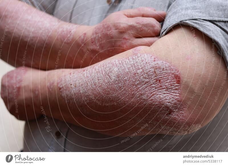 Psoriasis skin with red wounds. Male arms with cracked, hard, horny, flaky skin. Dermatological problems of allergy, eczema. Hand stains, rash, dry skin. The concept of chronic disease treatment