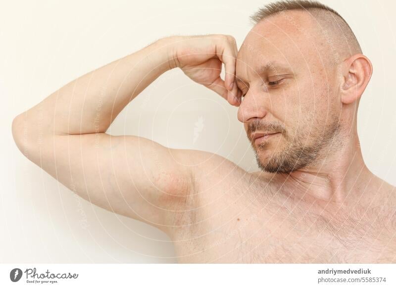 Young man shows irritation on the sensitive skin after using a razor, trimmer, toxic deodorant or antiperspirant. Armpit rash. Allergy, irritation or atopic dermatitis. Acne or red spots underarm.