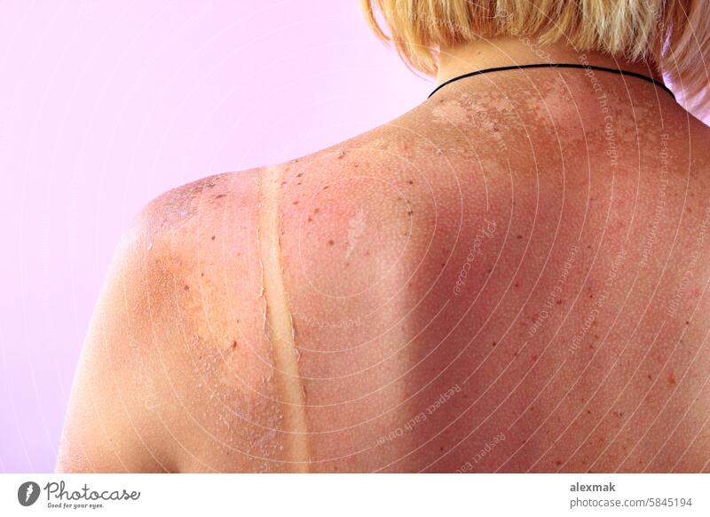 Traces of sunburn on the back of a woman. Female body burnt skin scald red pink cancer trace summer allergy cancerous care caucasian damage dangerous female