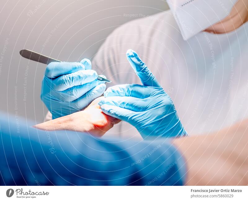 Close-up of a podiatry treatment. Selective focus closeup hand glove chiropody foot doctor nail pedicure bunion patient female medicine chiropodist fungus