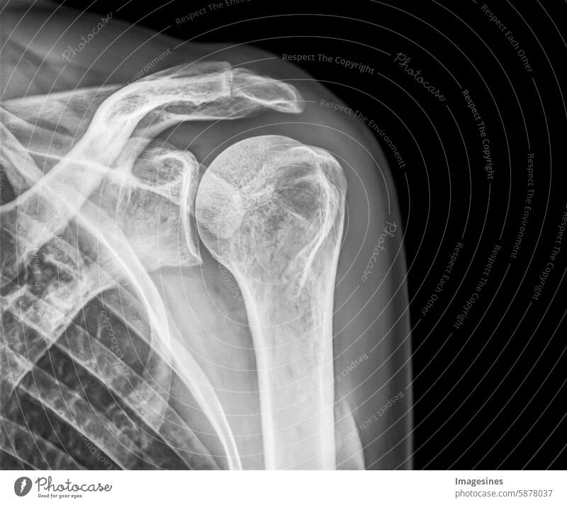 Patient with shoulder pain without findings. Part of a human female shoulder, high-quality X-ray image on a black background in blue tones. Medical concept