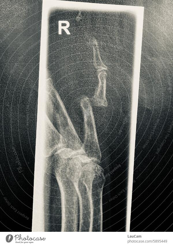 Ouch! Finger dislocation Accident accident sequence luxation Pain X-ray photograph X-ray of the hand wounded violation painful Hurt Body medicine Trauma