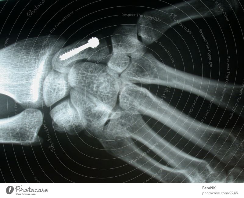 Screwed Hand X-ray photograph Skeleton Obscure Radiology
